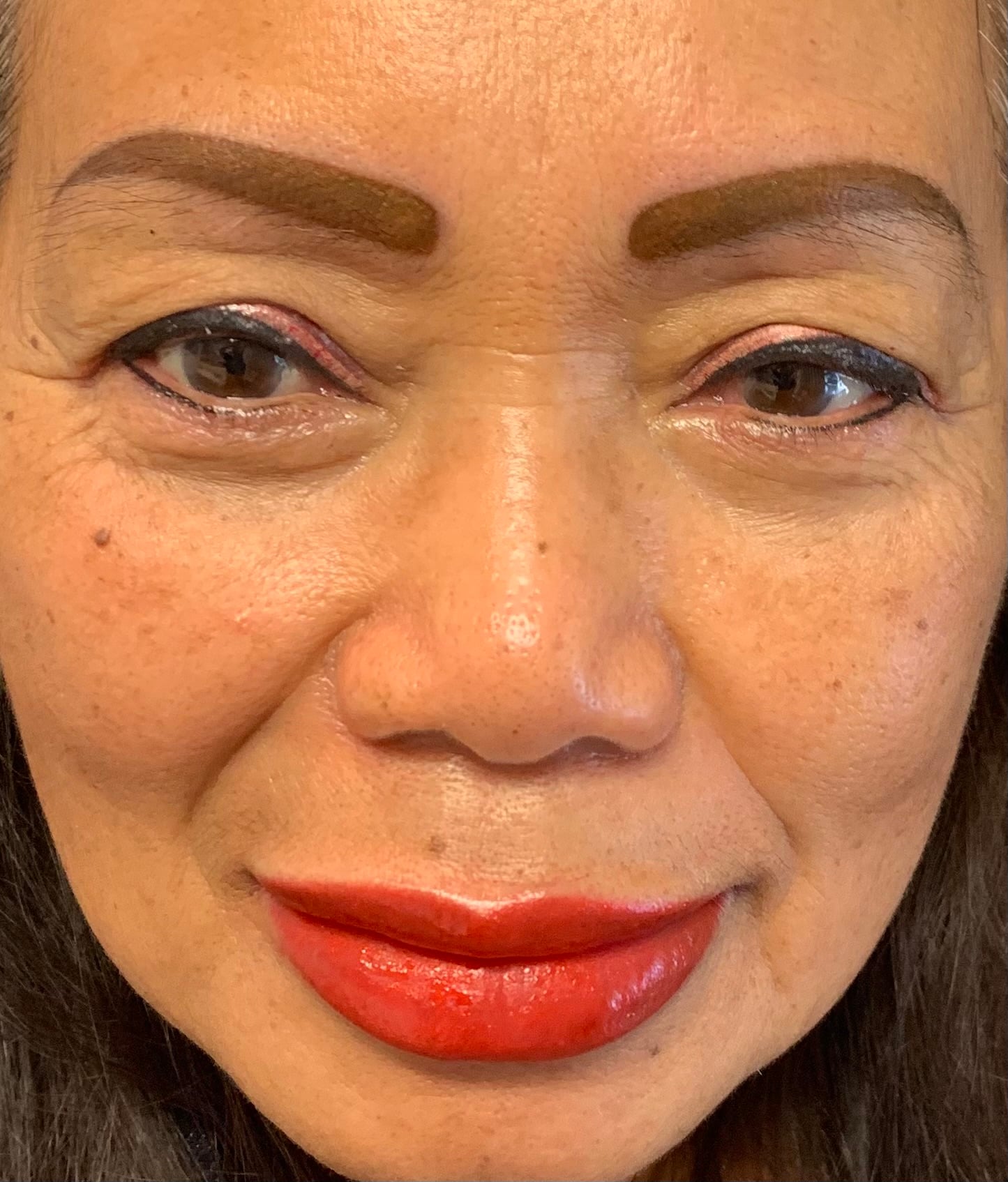 Whole face that is still swelling after procedure