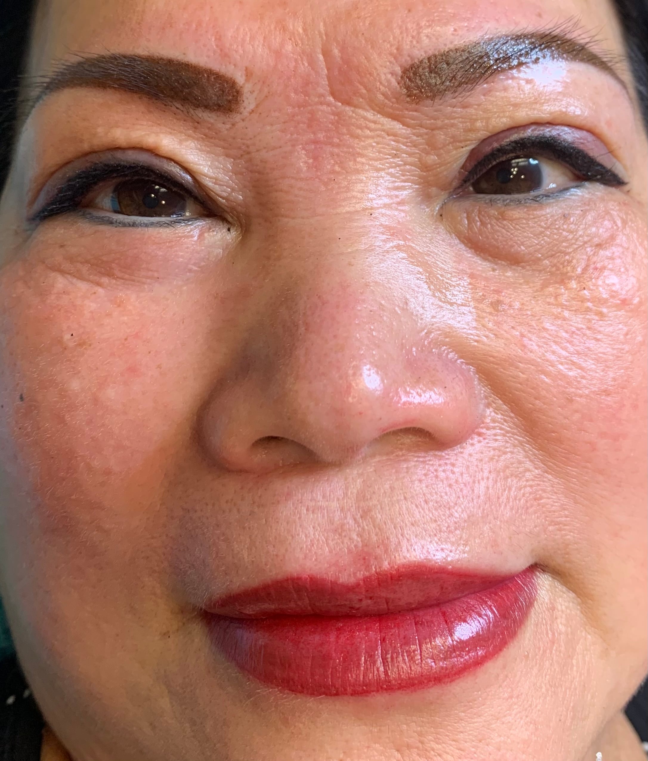 Whole face that is still swelling after procedure